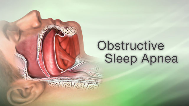 What is Obstructive Sleep Apnea?