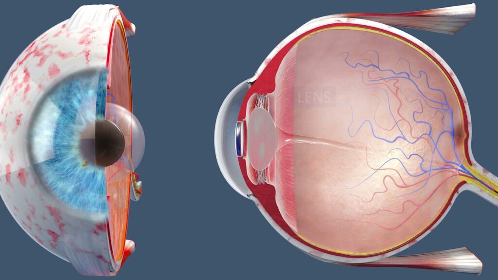 Cataract Surgery