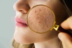 Acne Symptoms and Signs